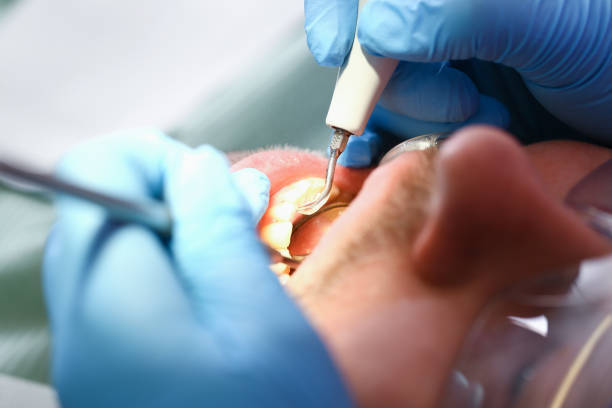 Best Broken Tooth Emergency  in Roswell, GA